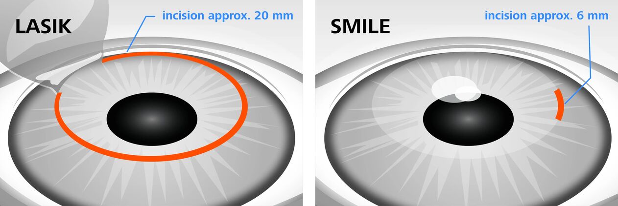 Vergleich der Laser-Sehkorrekturmethoden LASIK und SMILE